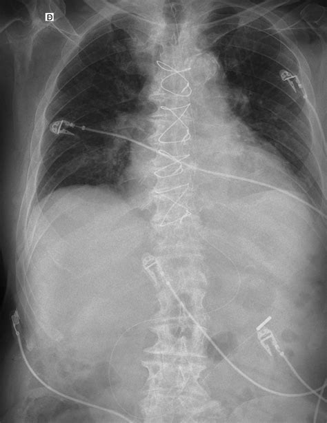 Radiograf A Toracoabdominal Ap Con El Paciente En Dec Bito Dorsal Se