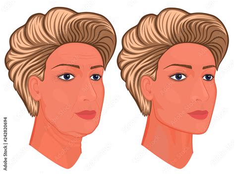Vector Illustration A Female Face Before After Plastic Surgery Facial Rejuvenation Face