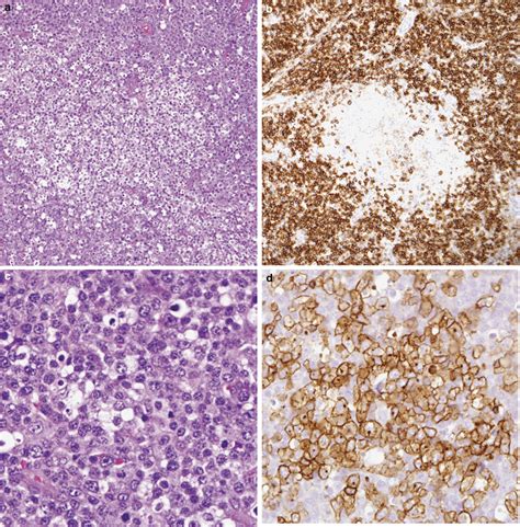 It is slightly more common in men than in women. Angioimmunoblastic T-cell lymphoma partially obscured by a ...