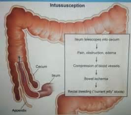 Complications are problems caused by your condition. Bowel Obstruction | Emergency nursing, Bowel obstruction ...