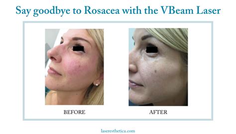 Say Goodbye To Rosacea With The Vbeam Laser Prasad Nalini