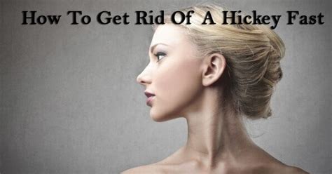 common ways to remove love bite how to get rid of a hickey ~ article to day free