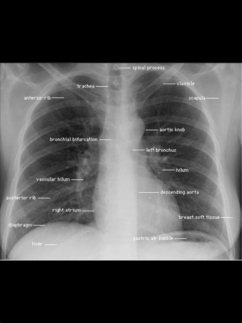 Normal Labelled Chest X Ray With Cardiovascular Structures My Xxx Hot Girl