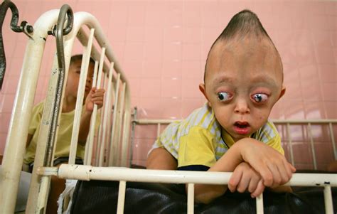 This Is A Child In Vietnam Born With A Birth Defect Due To His Parents