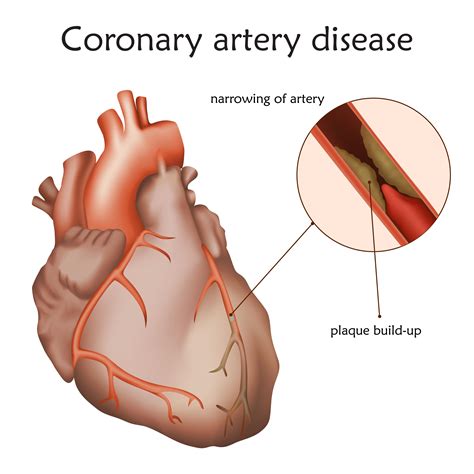 Coronary Artery Disease Lathrup Village MI Heart And Vein Center