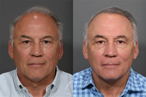 Male Crown Hair Restoration Before After Photo Gallery Serving