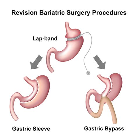 Gastric Bypass Revision Long Beach Ca Los Angeles Ca