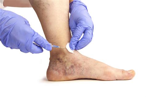 Varicose Veins Find Relief At Last With Varicose Vein Removal They