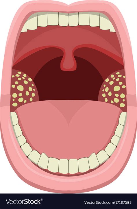 Inflamed Tonsillitis In Design Royalty Free Vector Image
