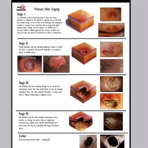 Wound Stages Pressure Ulcer Staging Nursing Study Pressure Ulcer