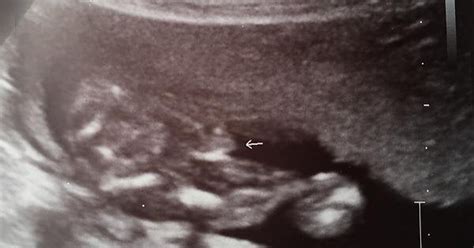 20 Week Gender Ultrasound Rpregnant