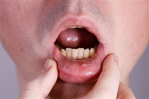 Mucocele Surgery In Panama What Is It And When To Do It