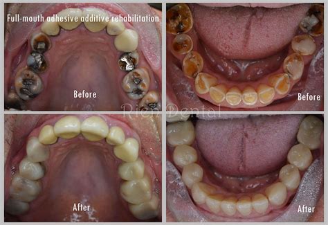 Full Mouth Rehabilitation Of The Worn Dentition