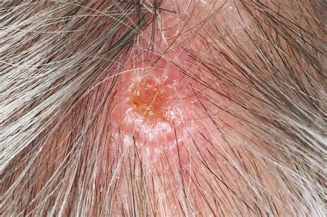 Squamous Cell Carcinoma Of The Scalp Stock Image C0033029