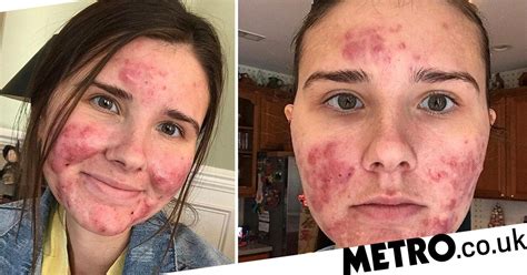 Whats It Like Leaving The House When You Have Cystic Acne Metro News