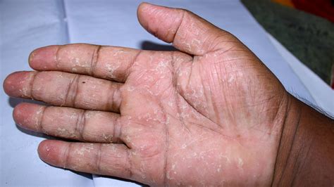 Palmar And Plantar Psoriasis Diagnosis Treatment And More