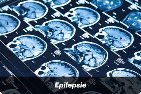Epilepsie Vallende Ziekte In 2020 Ontwenningsverschijnselen