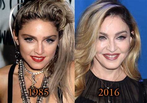 Madonna Plastic Surgery Before After Facelift Fillers Photos