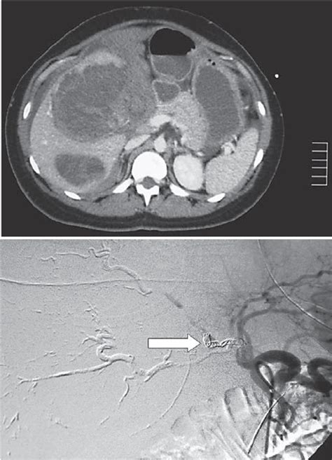 Contrast Enhanced Ct Scan Of The Liver Showing Several Ad Fig 2
