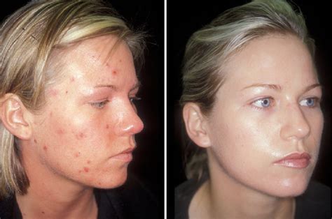 Home Natural Acne Treatment That Works