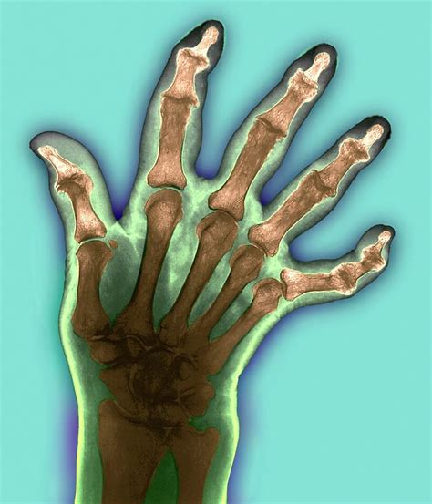 Arthritic Hand Photograph By Zephyrscience Photo Library Fine Art