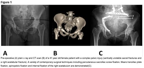 Pelvic and acetabular trauma care in Ireland: the past ...