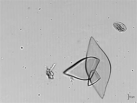 Davies mj, trujillo a, vijapurkar u, damaraju cv, meininger g. File:Uric acid crystals (urine) - Ürik asit kristalleri ...