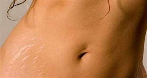 Stretch Marks Worry Expectant Mothers Most Survey