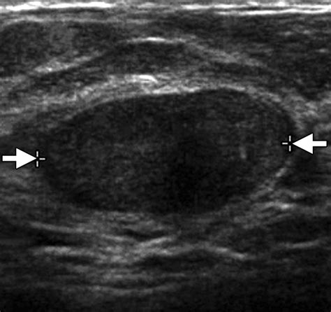 Us Of Breast Masses Categorized As Bi Rads 3 4 And 5 Pictorial