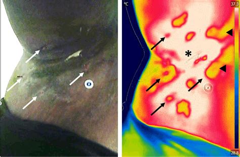 Frontiers Infrared Thermography In Wound Care Surgery And Sports