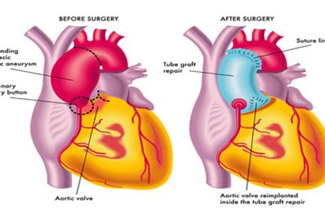 Aortic Aneurysm Repair Thoracic Artery