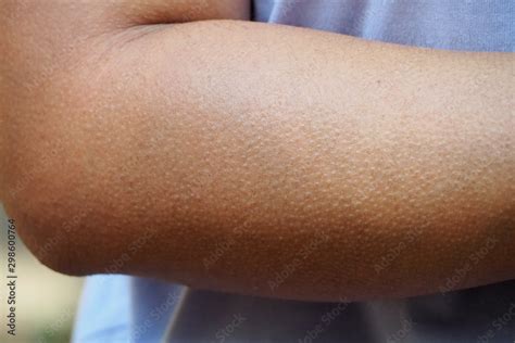 Human Skin Getting Goosebumps On Arm When Feeling Cold Or Creepy Seeing
