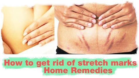 How To Get Rid Of Stretch Marks Stretch Marks How To Get Rid How To Get