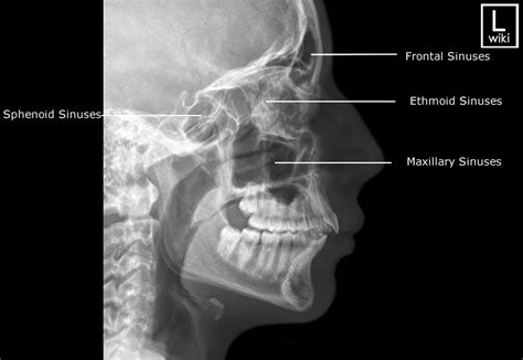 Patient positioned with chin pa 1. Radiographic Anatomy - Sinuses - Lateral | Radiologia | Radiología, Radiografia de craneo ...