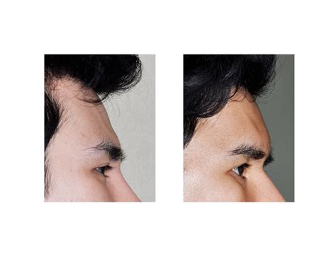 Male Forehead Augmentation Indianapolis Dr Barry Eppley Explore