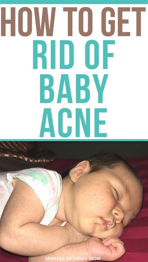 How To Get Rid Of Baby Acne An Instant Remedy The Baby Acne