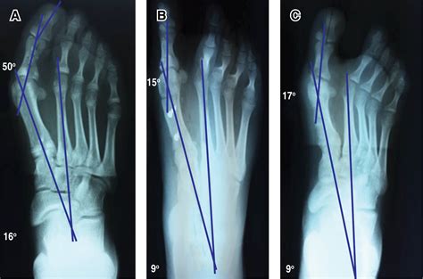Radiographic Results Of The Treatment Of Hallux Valgus Juvenile With