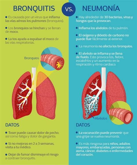 Diferencias Entre Bronquitis Y Pulmon A Cuadros Comparativos Cuadro