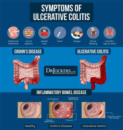 What Is Ulcerative Colitis Causes Signs And Symptoms The Best Porn