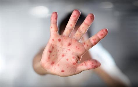 How To Spot Measles Symptoms And Identify The Rash In Children Metro News