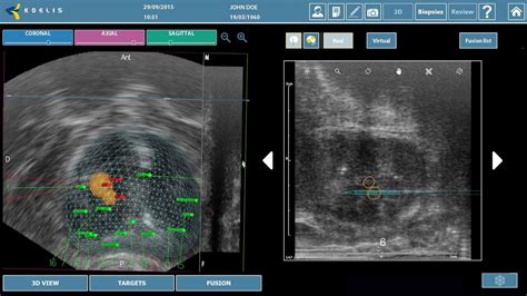 Targeted Prostate Biopsy Using Mrultrasound Fusion Trinity Youtube