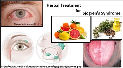 Herbal Treatment For Sjogrens Syndrome Dry Mouth And Eye Herbs