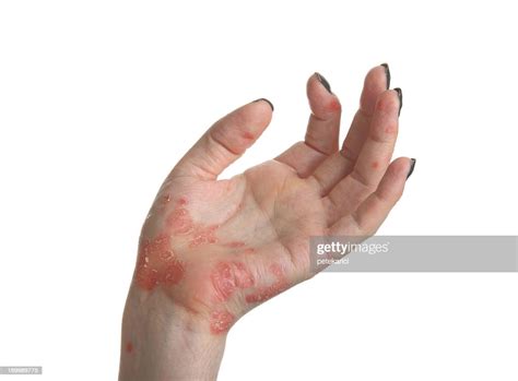 Psoriasis Hand High Res Stock Photo Getty Images