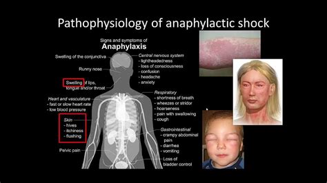 Pathophysiology Of Anaphylactic Shock Youtube