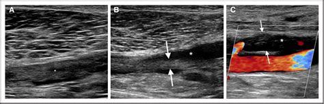 Figure 4 From Ultrasound For Lower Extremity Deep Venous Thrombosis Multidisciplinary