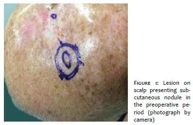 Surgical Cosmetic Dermatology Ductal Eccrine Carcinoma Diagnostic