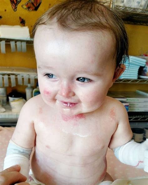 Butterfly Baby With Incurable Rare Skin Condition Which Leaves Her