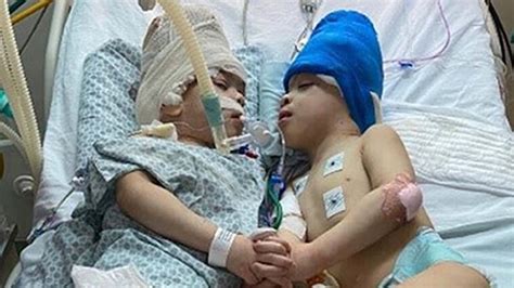 Conjoined Brazilian Twins Are Successfully Separated