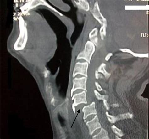 Ct Scan Of Cervical Spine Revealing Partial Anterior Su