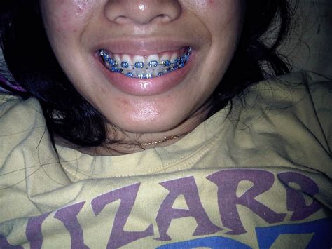 Tribute From January Braces Girl